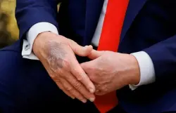 كدمة جديدة على يد ترامب تثير الجدل حول صحته… والبيت الأبيض يوضح